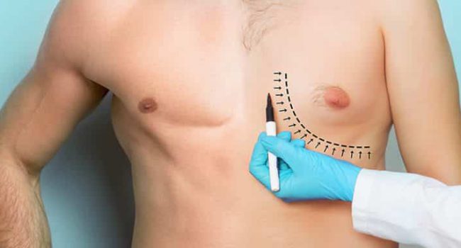 Gynecomastie-1-1-768x384