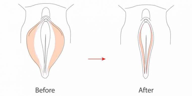 Labioplastie1-768x384