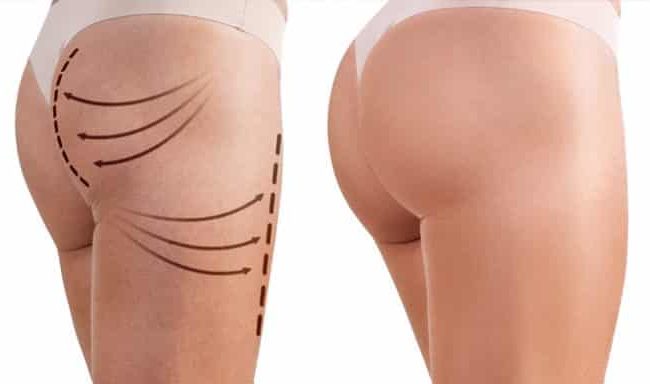 Lipofilling-des-fesses3-768x384